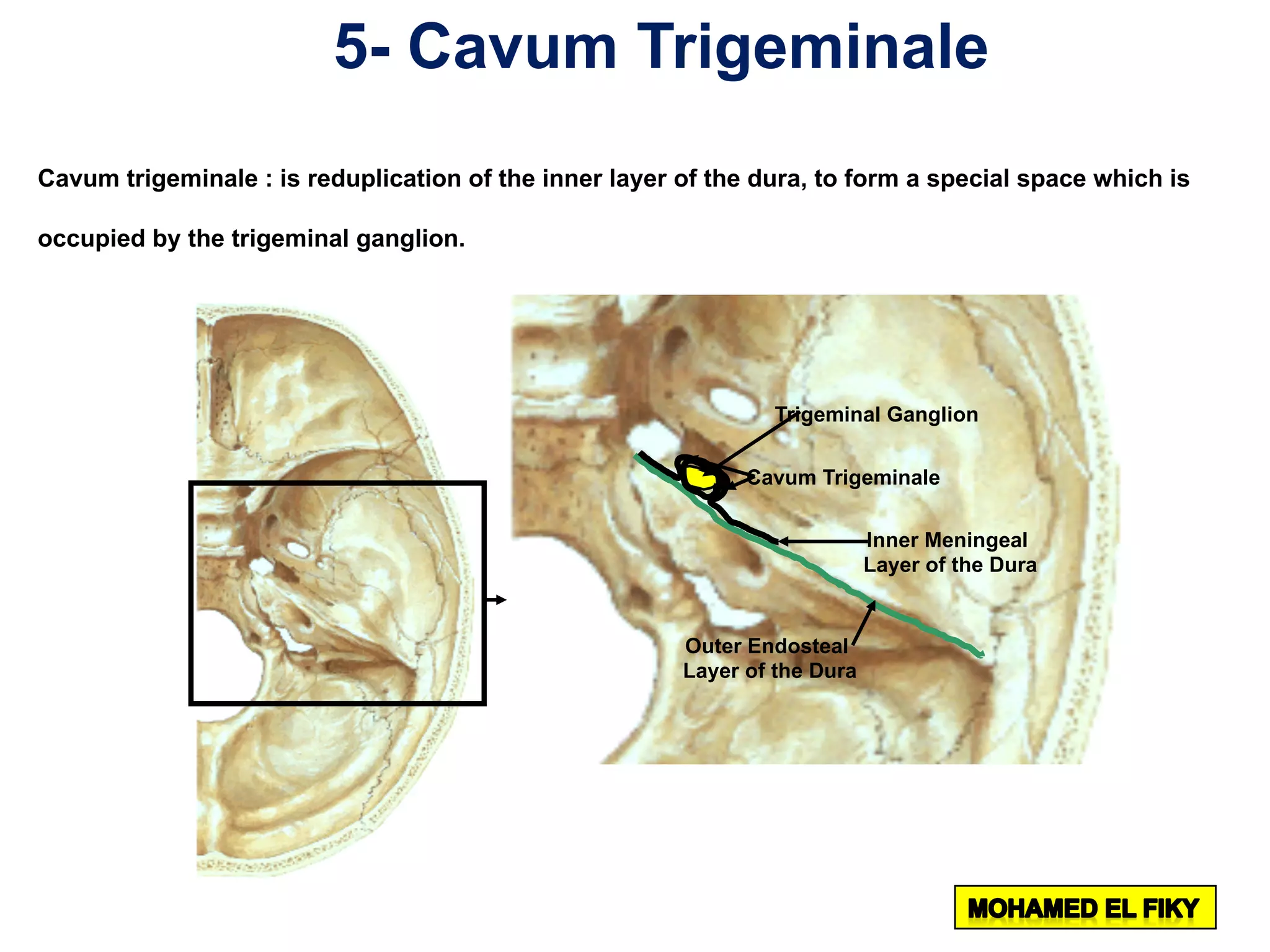 5- Cavum Trigeminale
Cavum trigeminale : is reduplication of the inner layer of the dura, to form a special space which is
occupied by the trigeminal ganglion.
Trigeminal Ganglion
Cavum Trigeminale
Outer Endosteal
Layer of the Dura
Inner Meningeal
Layer of the Dura
 