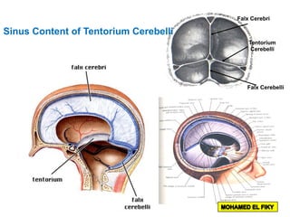 Falx Cerebri
Falx Cerebelli
Tentorium
Cerebelli
Sinus Content of Tentorium Cerebelli
 