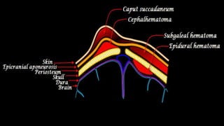 Cranial hematomas (injury)