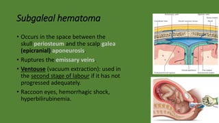 Subgaleal hematoma
• Occurs in the space between the
skull periosteum and the scalp galea
(epicranial) aponeurosis.
• Ruptures the emissary veins.
• Ventouse (vacuum extraction): used in
the second stage of labour if it has not
progressed adequately.
• Raccoon eyes, hemorrhagic shock,
hyperbilirubinemia.
 