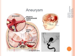 1/24/2015©2009,
AmericanHeart
Association.Allrights
reserved.
Aneurysm
 