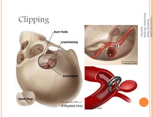 1/24/2015©2009,
AmericanHeart
Association.Allrights
reserved.
Clipping
 