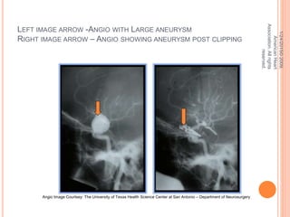 LEFT IMAGE ARROW -ANGIO WITH LARGE ANEURYSM
RIGHT IMAGE ARROW – ANGIO SHOWING ANEURYSM POST CLIPPING
1/24/2015©2009,
AmericanHeart
Association.Allrights
reserved.
Angio Image Courtsey: The University of Texas Health Science Center at San Antonio – Department of Neurosurgery
 
