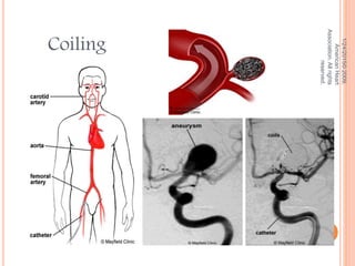 1/24/2015©2009,
AmericanHeart
Association.Allrights
reserved.
Coiling
 
