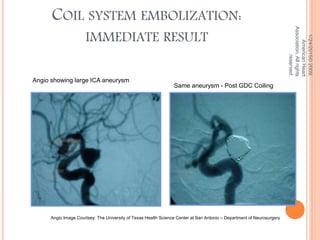 COIL SYSTEM EMBOLIZATION:
IMMEDIATE RESULT
1/24/2015©2009,
AmericanHeart
Association.Allrights
reserved.
Angio showing large ICA aneurysm
Same aneurysm - Post GDC Coiling
Angio Image Courtsey: The University of Texas Health Science Center at San Antonio – Department of Neurosurgery
 