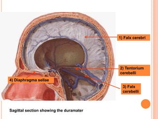 Sagittal section showing the duramater
1) Falx cerebri
2) Tentorium
cerebelli
3) Falx
cerebelli
4) Diaphragma sellae
 