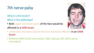 7th nerve palsy
Where is the lesion?
What is the pathology?
• Both upper and lower parts of the face would be
affected in a LMN lesion
• while only the lower part of the face would be affected in an UMN
lesion
• Bilateral LMN Facial nerve palsy- GBS, Leprosy, B/L Bell’s palsy,
sarcoidosis
 
