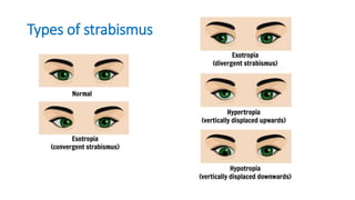 Types of strabismus
 