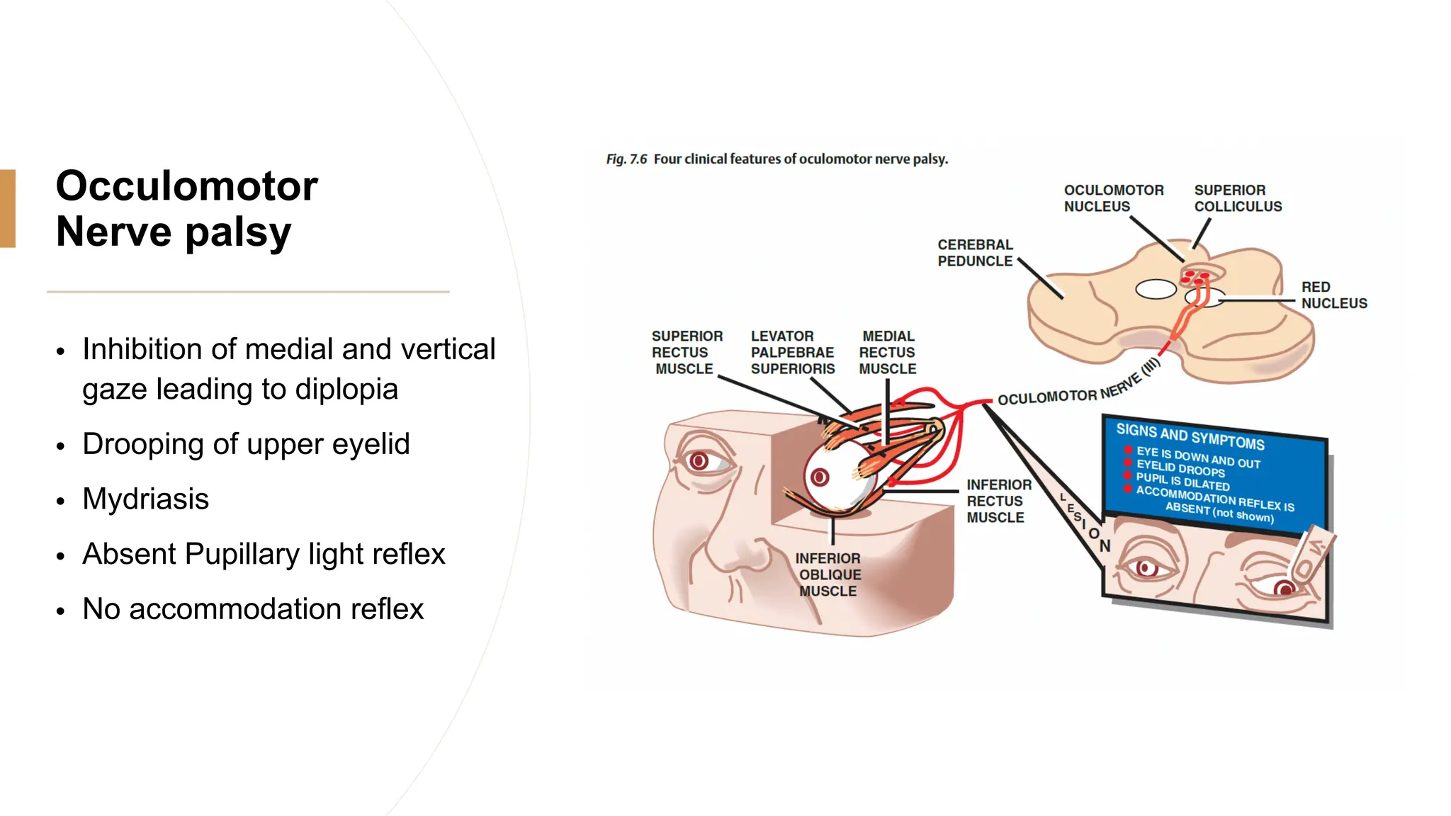 Occulomotor
Nerve palsy
• Inhibition of medial and vertical
gaze leading to diplopia
• Drooping of upper eyelid
• Mydriasis
• Absent Pupillary light reflex
• No accommodation reflex
 