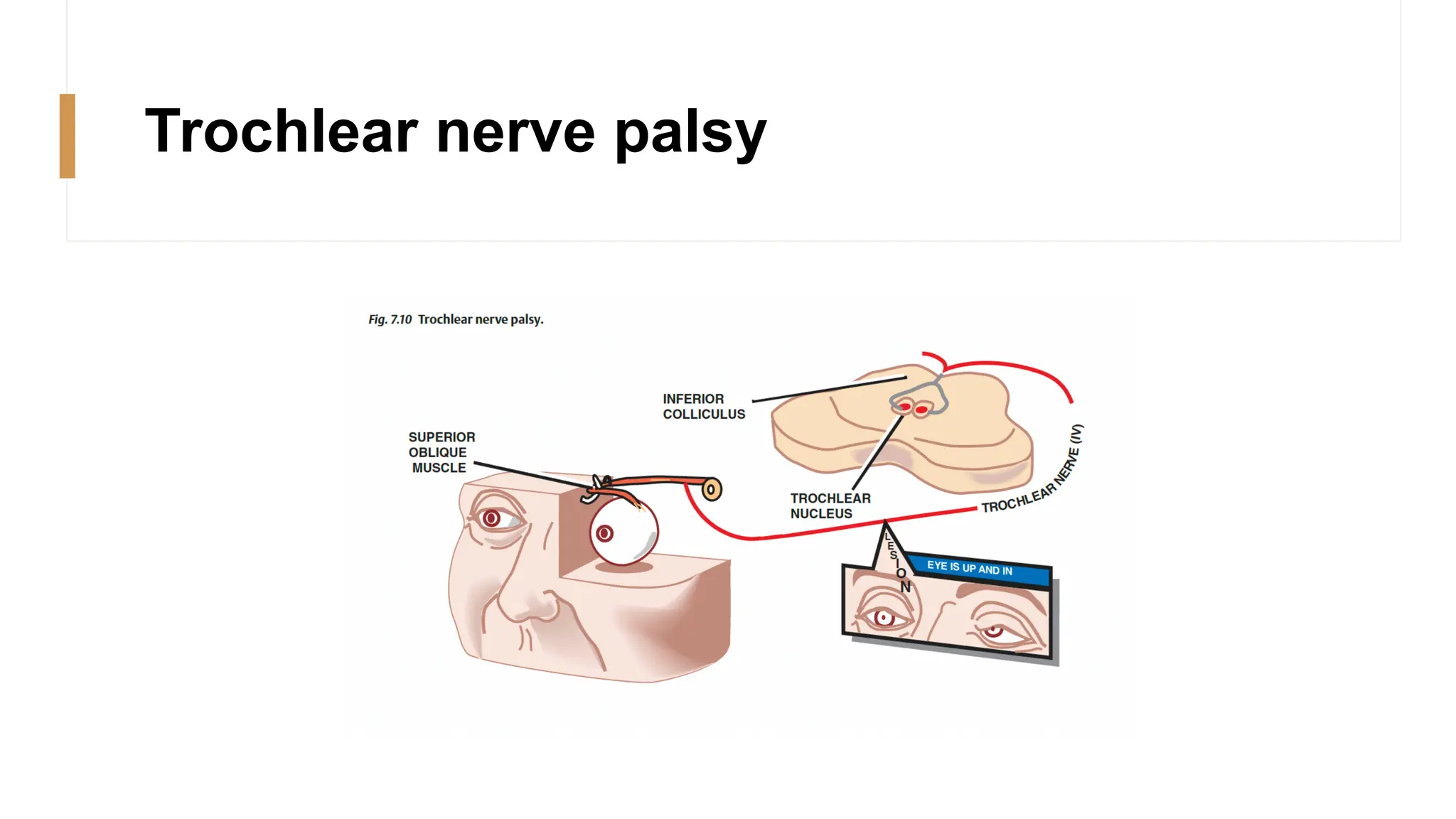 Trochlear nerve palsy
 