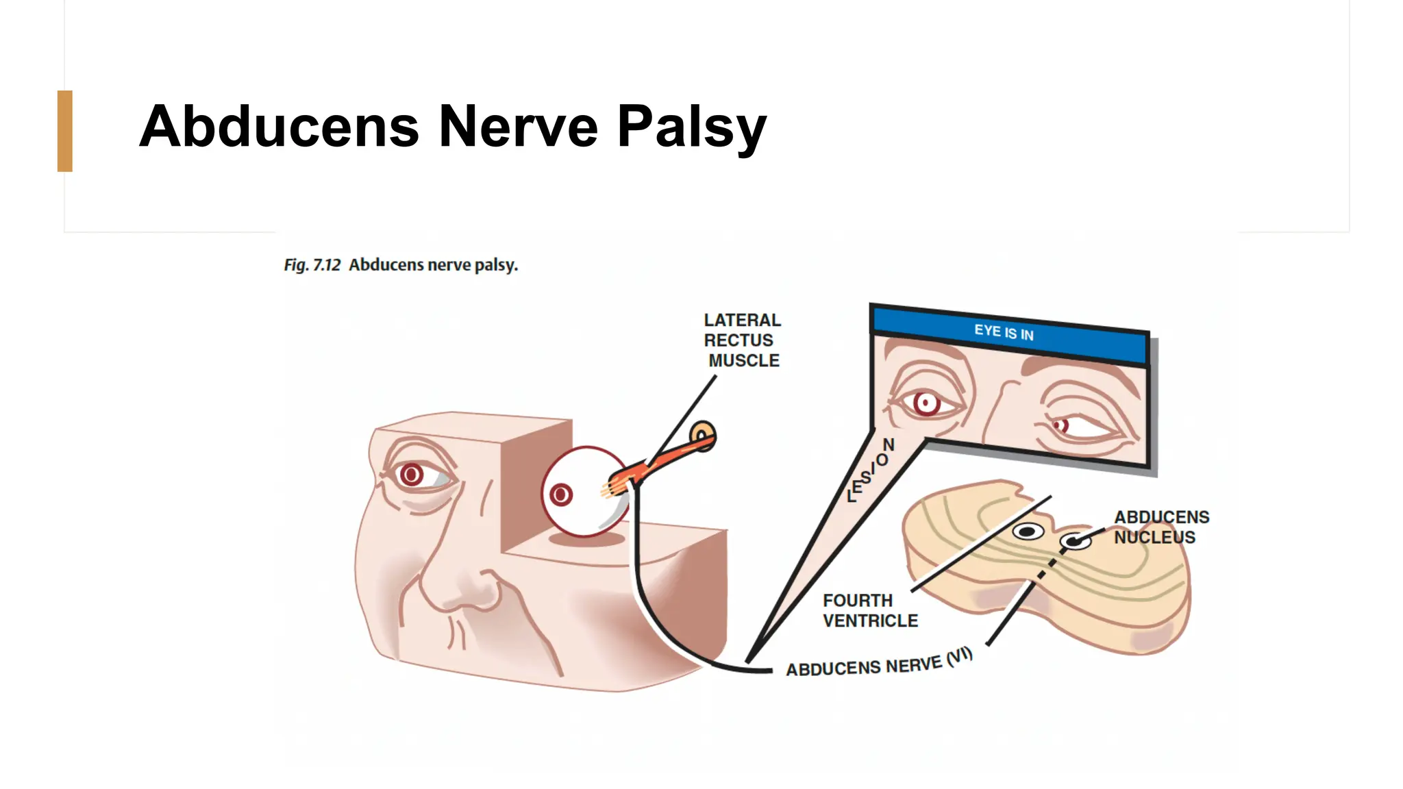 Abducens Nerve Palsy
 