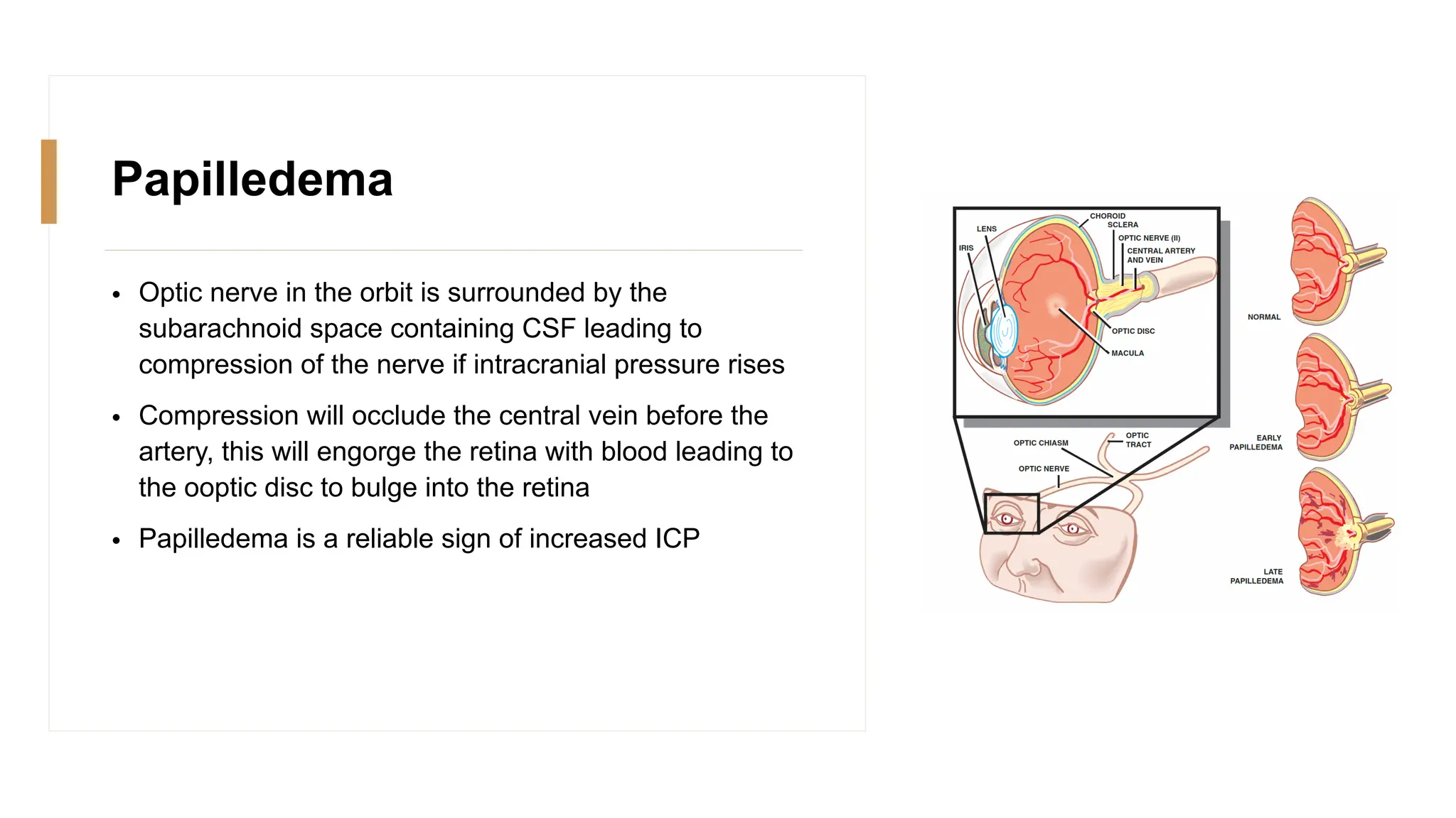 Papilledema
• Optic nerve in the orbit is surrounded by the
subarachnoid space containing CSF leading to
compression of the nerve if intracranial pressure rises
• Compression will occlude the central vein before the
artery, this will engorge the retina with blood leading to
the ooptic disc to bulge into the retina
• Papilledema is a reliable sign of increased ICP
 