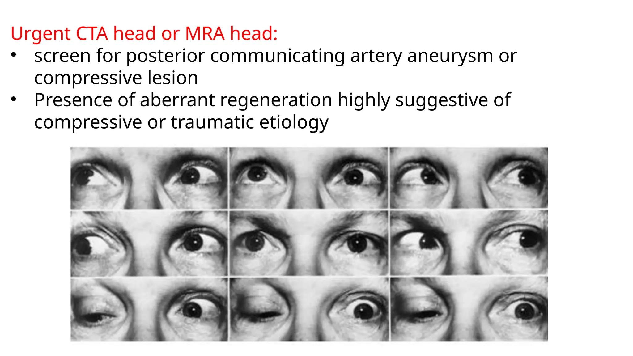 Urgent CTA head or MRA head:
• screen for posterior communicating artery aneurysm or
compressive lesion
• Presence of aberrant regeneration highly suggestive of
compressive or traumatic etiology
 