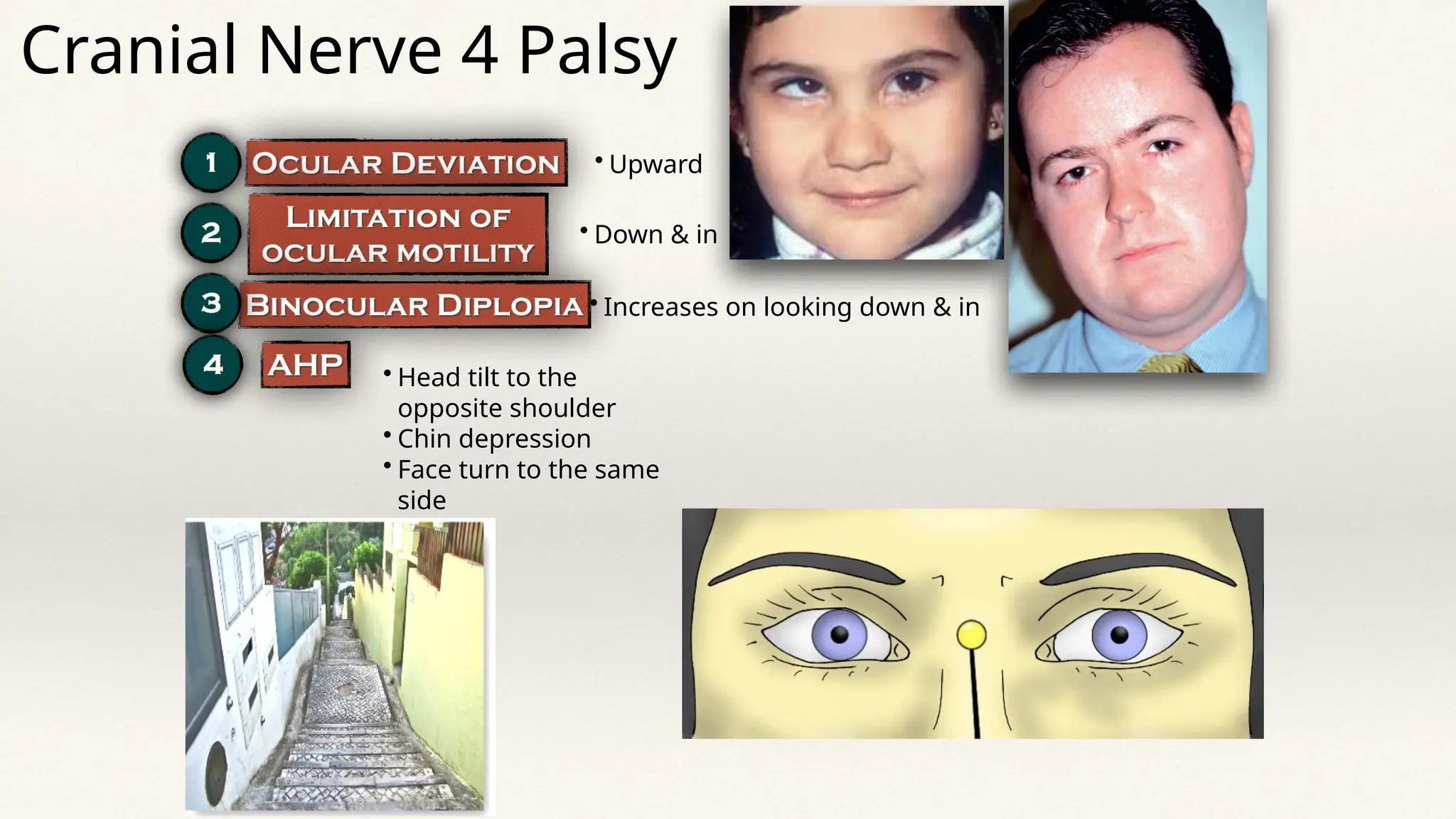 • Upward
• Down & in
• Increases on looking down & in
• Head tilt to the
opposite shoulder
• Chin depression
• Face turn to the same
side
Cranial Nerve 4 Palsy
 