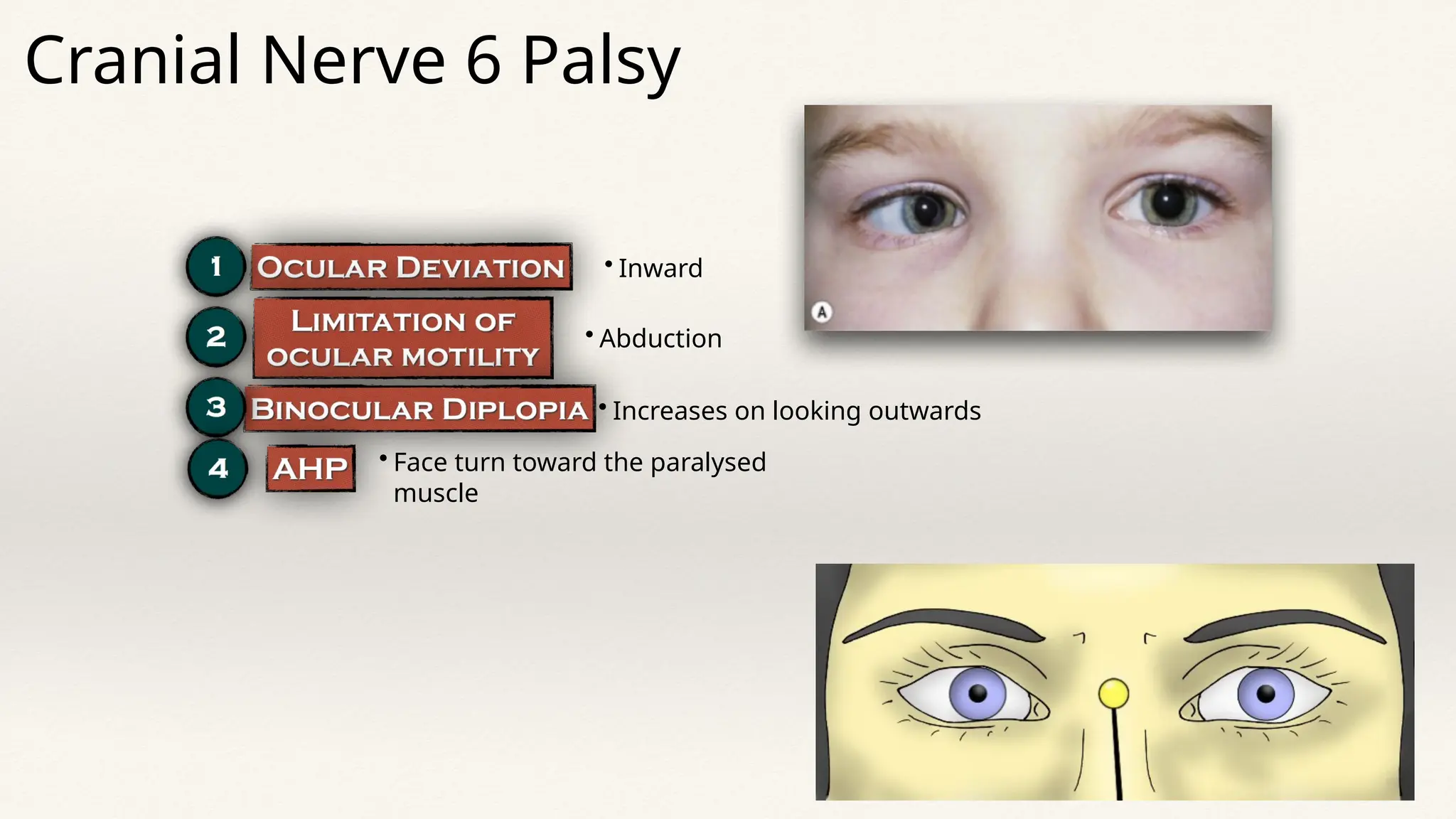 • Inward
• Abduction
• Increases on looking outwards
• Face turn toward the paralysed
muscle
Cranial Nerve 6 Palsy
 