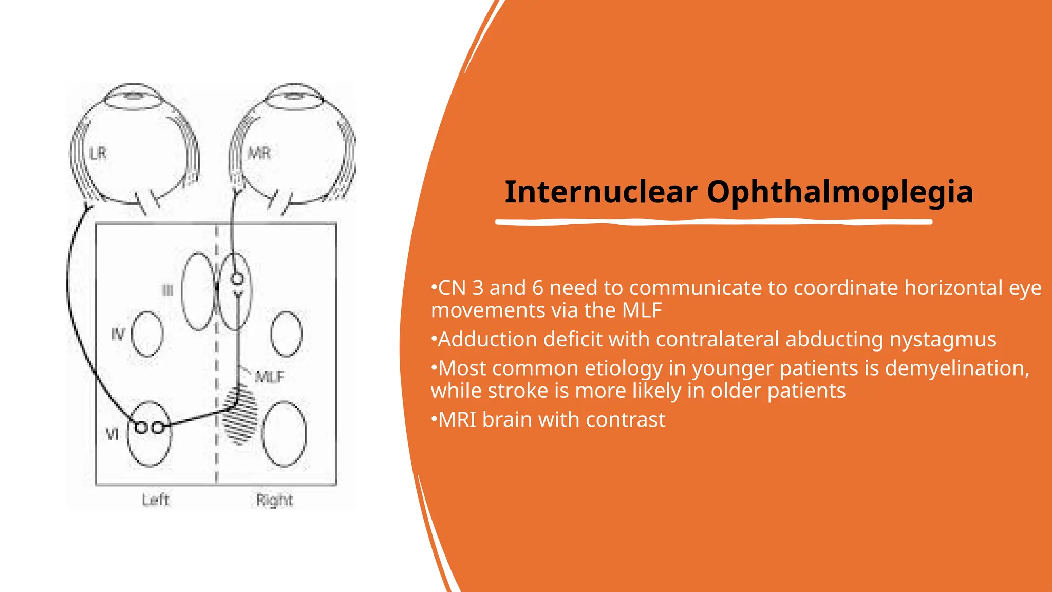 •CN 3 and 6 need to communicate to coordinate horizontal eye
movements via the MLF
•Adduction deficit with contralateral abducting nystagmus
•Most common etiology in younger patients is demyelination,
while stroke is more likely in older patients
•MRI brain with contrast
Internuclear Ophthalmoplegia
 