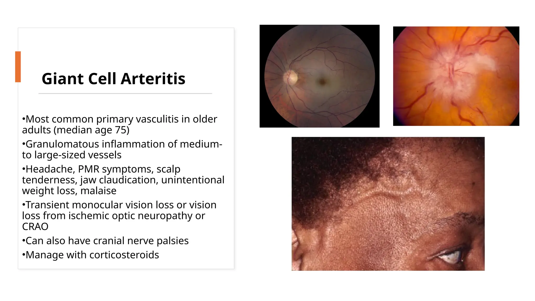 •Most common primary vasculitis in older
adults (median age 75)
•Granulomatous inflammation of medium-
to large-sized vessels
•Headache, PMR symptoms, scalp
tenderness, jaw claudication, unintentional
weight loss, malaise
•Transient monocular vision loss or vision
loss from ischemic optic neuropathy or
CRAO
•Can also have cranial nerve palsies
•Manage with corticosteroids
Giant Cell Arteritis
 