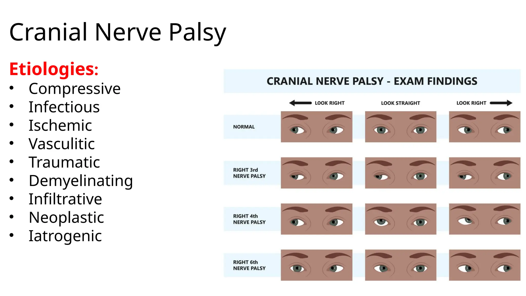 Cranial Nerve Palsy
Etiologies:
• Compressive
• Infectious
• Ischemic
• Vasculitic
• Traumatic
• Demyelinating
• Infiltrative
• Neoplastic
• Iatrogenic
 