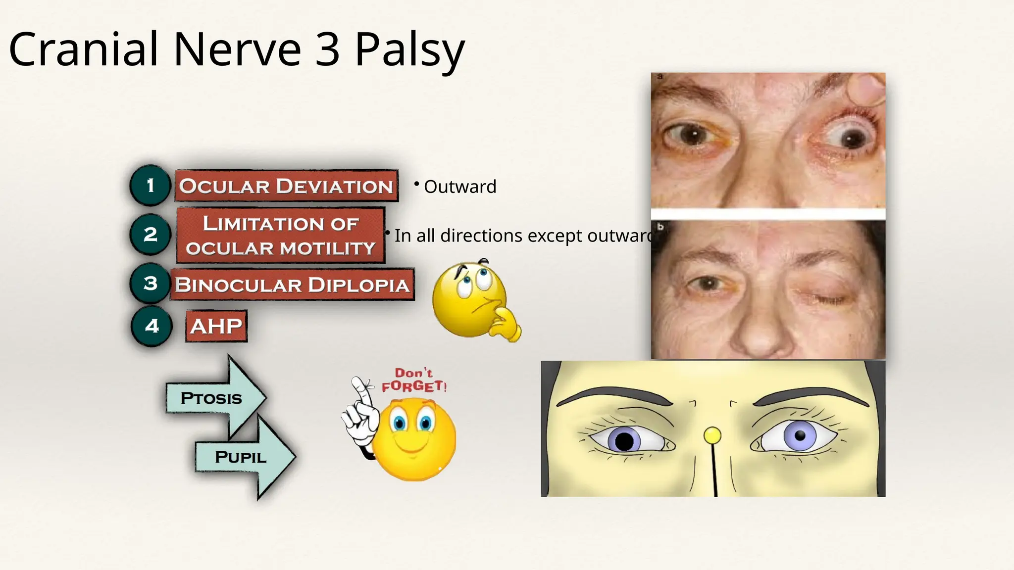 • Outward
• In all directions except outward
Cranial Nerve 3 Palsy
 