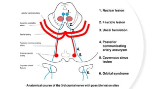 How to deal with 3,4 and 6 cranial nerve palsy | PPTX