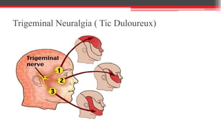 Trigeminal Neuralgia ( Tic Duloureux)
 