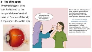 2- The blind spot:
The physiological blind
spot is situated to the
temporal side of central
point of fixation of the VF,
It represents the optic disc
 