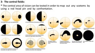 3- The central fields:
* The central area of vision can be tested in order to map out any scotoms by
using a red head pin and by confrontation.
 
