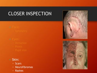 CLOSER INSPECTION
•
•
• Skin:
▫ Scars
▫ Neurofibromas
▫ Rashes
 