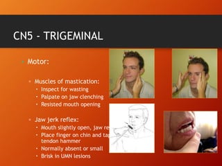 CN5 - TRIGEMINAL
• Motor:
▫ Muscles of mastication:
 Inspect for wasting
 Palpate on jaw clenching
 Resisted mouth opening
▫ Jaw jerk reflex:
 Mouth slightly open, jaw relaxed
 Place finger on chin and tap with
tendon hammer
 Normally absent or small
 Brisk in UMN lesions
 