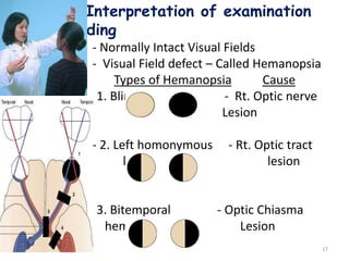 Interpretation of examination
Finding
- Normally Intact Visual Fields
- Visual Field defect – Called Hemanopsia
Types of Hemanopsia Cause
- 1. Blind Rt Eye - Rt. Optic nerve
Lesion
- 2. Left homonymous - Rt. Optic tract
He hemianopsia lesion
- 3. Bitemporal - Optic Chiasma
heminaopsia Lesion
17
 