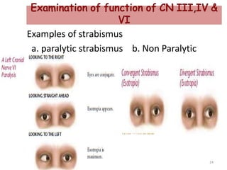 Examples of strabismus
a. paralytic strabismus b. Non Paralytic
24
 