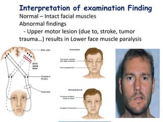Interpretation of examination Finding
Normal – Intact facial muscles
Abnormal findings
- Upper motor lesion (due to, stroke, tumor
trauma…) results in Lower face muscle paralysis
33
 