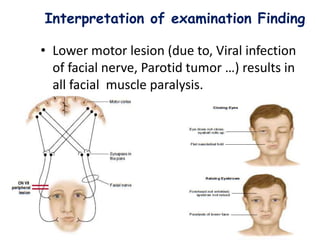 Interpretation of examination Finding
• Lower motor lesion (due to, Viral infection
of facial nerve, Parotid tumor …) results in
all facial muscle paralysis.
34
 