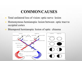 COMMONCAUSES
v Total unilateral loss of vision: optic nerve lesion
v Homonymous hemianopia: lesion between optic tract to
occipital cortex
v Bitemporal hemianopia: lesion of optic chiasma
 