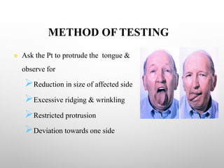 METHOD OF TESTING
v Ask the Pt to protrude the tongue &
observe for
ØReduction in size of affected side
ØExcessive ridging & wrinkling
ØRestricted protrusion
ØDeviation towards one side
 