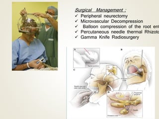 Surgical Management :
 Peripheral neurectomy
 Microvascular Decompression
 Balloon compression of the root ent
 Percutaneous needle thermal Rhizoto
 Gamma Knife Radiosurgery
 