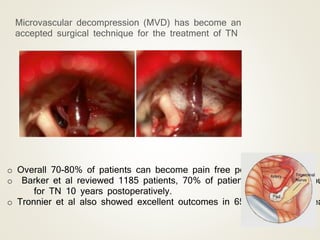 Microvascular decompression (MVD) has become an
accepted surgical technique for the treatment of TN
o Overall 70-80% of patients can become pain free post procedure.
o Barker et al reviewed 1185 patients, 70% of patients pain free withou
for TN 10 years postoperatively.
o Tronnier et al also showed excellent outcomes in 65% patients 10 yea
 