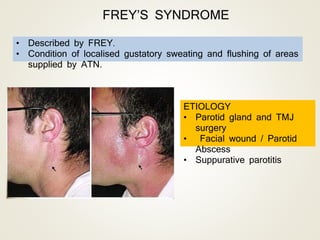 • Described by FREY.
• Condition of localised gustatory sweating and flushing of areas
supplied by ATN.
ETIOLOGY
• Parotid gland and TMJ
surgery
• Facial wound / Parotid
Abscess
• Suppurative parotitis
FREY’S SYNDROME
 