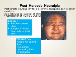 Post Herpetic Neuralgia.
Post-herpetic neuralgia (PHN) is a chronic neuropathic pain condition
months or
more following an outbreak of shingles.
Constant Deep,
Aching, Or Burning
Pain
Paroxysmal,
Lancinating Pain
Hyperalgesia
Allodynia
 Complication of HERPES ZOSTER infection.
Etiology :
• Peripheral nerve
injury
• Atrophy of dorsal
horn cells in spinal
cord.
• Low grade infection
of the ganglion
 