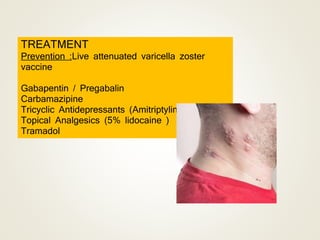 TREATMENT
Prevention :Live attenuated varicella zoster
vaccine
Gabapentin / Pregabalin
Carbamazipine
Tricyclic Antidepressants (Amitriptylin ,Doxepin )
Topical Analgesics (5% lidocaine )
Tramadol
 