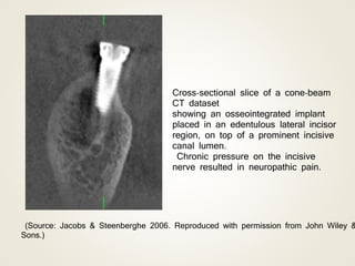 Cross‐sectional slice of a cone‐beam
CT dataset
showing an osseointegrated implant
placed in an edentulous lateral incisor
region, on top of a prominent incisive
canal lumen.
Chronic pressure on the incisive
nerve resulted in neuropathic pain.
(Source: Jacobs & Steenberghe 2006. Reproduced with permission from John Wiley &
Sons.)
 