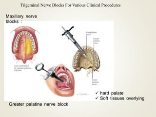 Trigeminal Nerve Blocks For Various Clinical Procedures
Maxillary nerve
blocks :
Greater palatine nerve block
 hard palate
 Soft tissues overlying
 