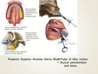 Posterior Superior Alveolar Nerve Block Pulps of Max molars.
 Buccal periodontium
and bone.
 