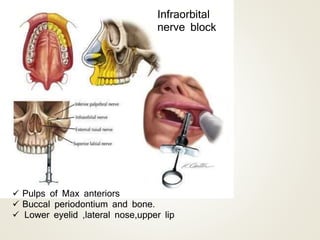 Infraorbital
nerve block
 Pulps of Max anteriors
 Buccal periodontium and bone.
 Lower eyelid ,lateral nose,upper lip
 