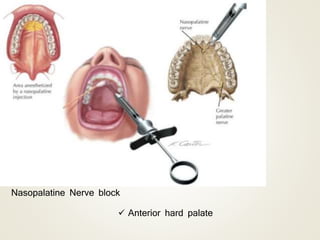 Nasopalatine Nerve block
 Anterior hard palate
 
