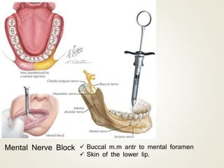 Mental Nerve Block  Buccal m.m antr to mental foramen
 Skin of the lower lip.
 