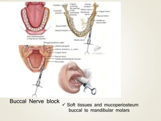 Buccal Nerve block
 Soft tissues and mucoperiosteum
buccal to mandibular molars
 