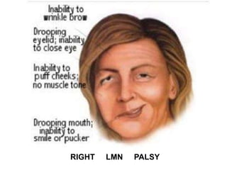 RIGHT LMN PALSY
 