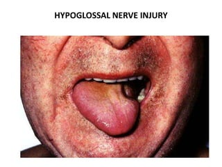 HYPOGLOSSAL NERVE INJURY
 