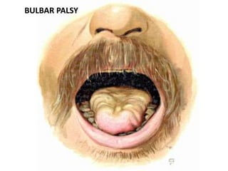 BULBAR PALSY
 